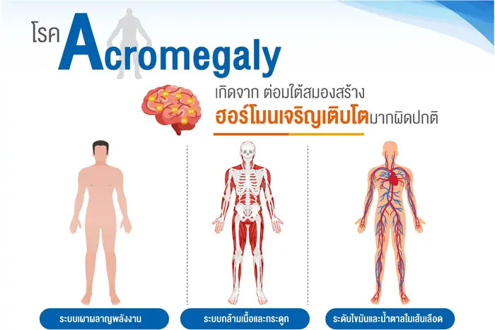 “อะโครเมกาลี” โรคหายาก สิทธิบัตรทองใช้รักษาได้