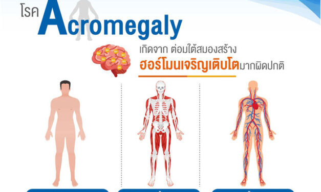 “อะโครเมกาลี” โรคหายาก สิทธิบัตรทองใช้รักษาได้